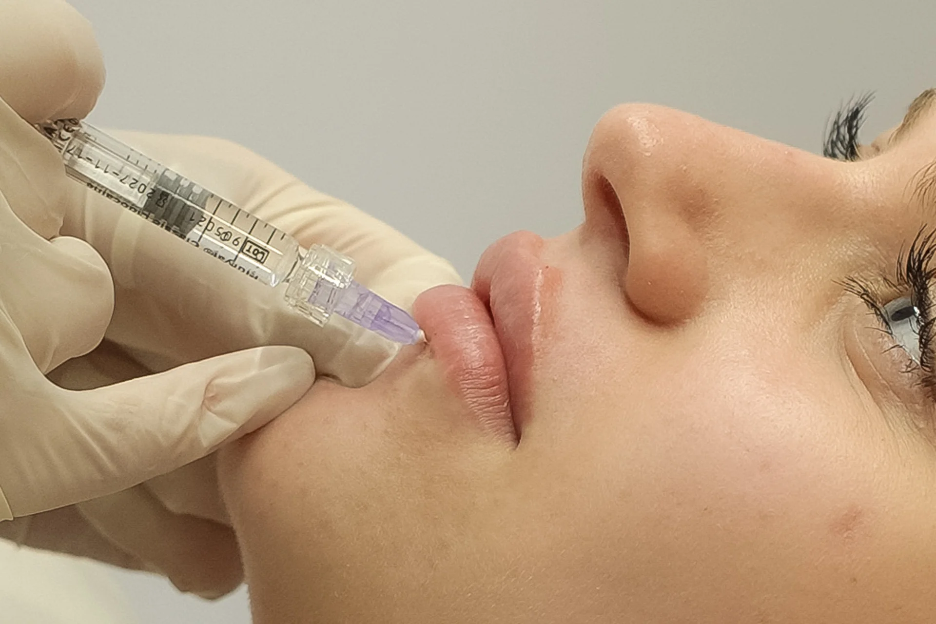 Контурна пластика губ у RESET Clinic у Львові